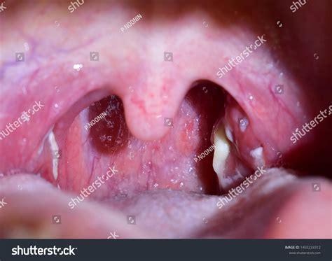 pussing picture|tonsils with pus pictures.